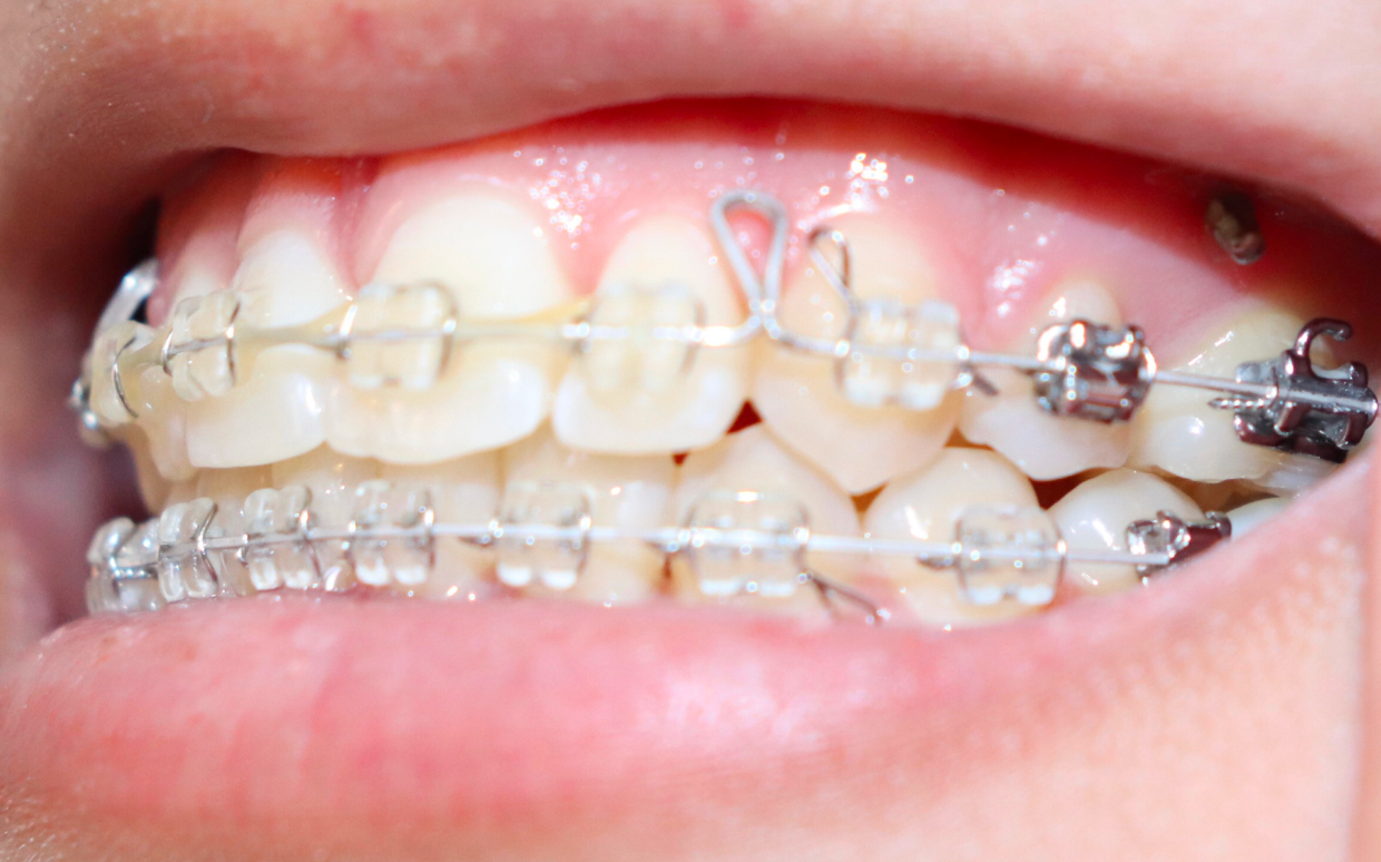 歯科矯正用アンカースクリュー