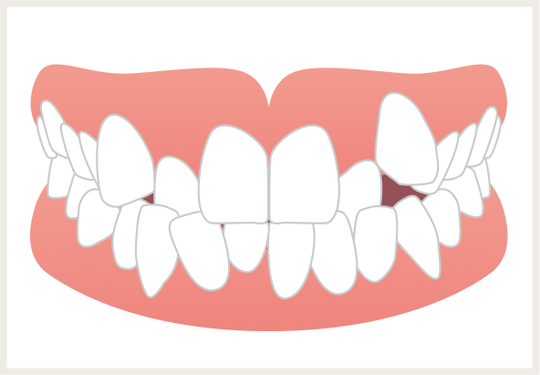 叢生（そうせい）