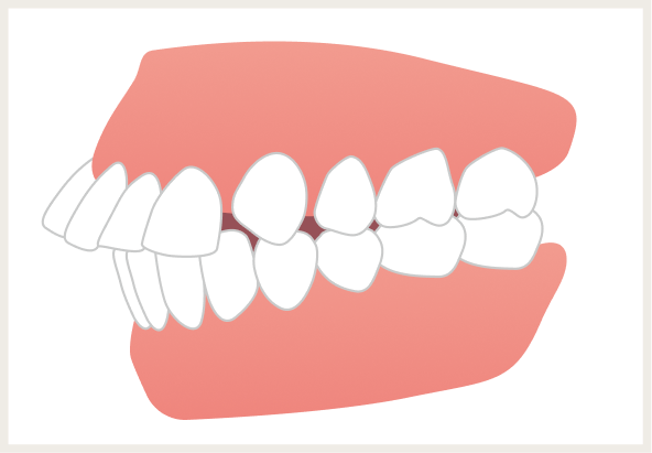 上顎前突（じょうがくぜんとつ）