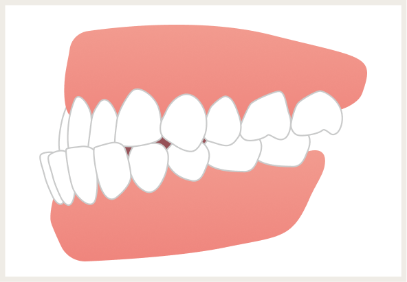 反対咬合（はんたいこうごう）