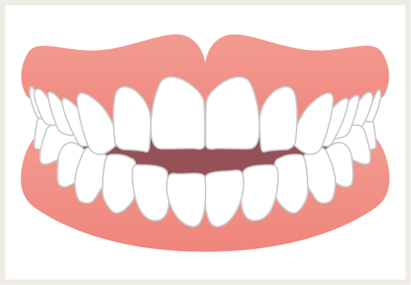 開咬（かいこう）