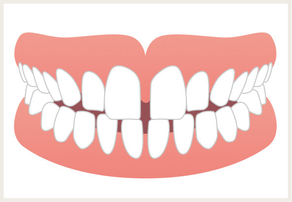 空隙歯列（くうげきしれつ）